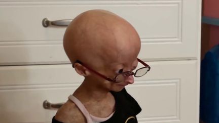 Maladie : une découverte suscite l'espoir de guérir de la progeria