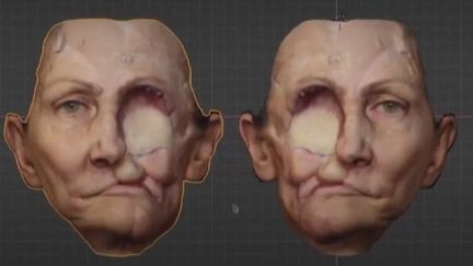 Reconstruction facile : un nouveau visage grâce à l'impression 3D