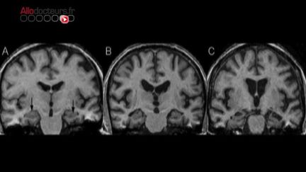 La recherche sur les maladies neurodégénératives est-elle en crise?