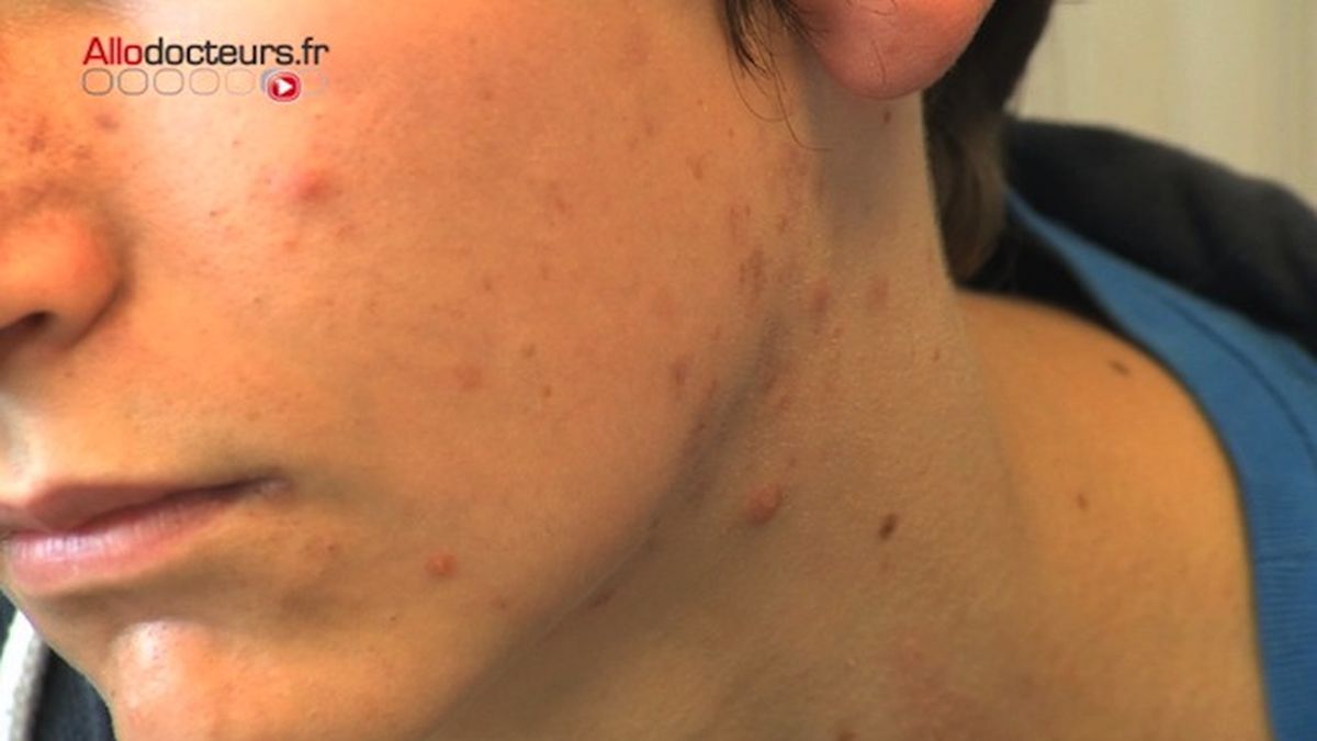 Roaccutane sans pillule