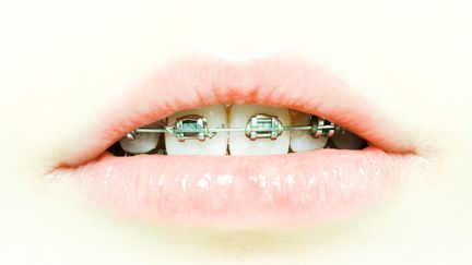 La Fédération française d'orthodontie (FFO) met en garde, vendredi&nbsp;18 décembre, contre les vidéos permettant de&nbsp;fabriquer un appareil dentaire maison. (MAXPPP)