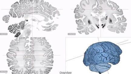 Une &eacute;quipe internationale de chercheurs a d&eacute;voil&eacute;, jeudi 20 juin, le premier mod&egrave;le en trois dimensions (3D) du cerveau humain avec une r&eacute;solution microscopique. Elle est 50 fois plus d&eacute;taill&eacute;e que les images r&eacute;alis&eacute;es jusqu'alors. (BIGBRAIN / CBRAIN PLATFORM / YOUTUBE.COM / FRANCETV INFO)