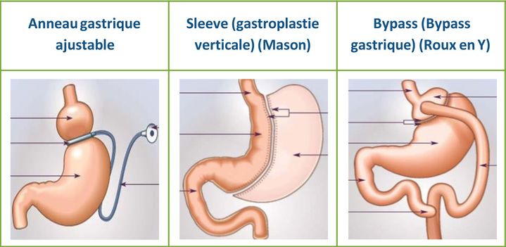 Schéma de trois opérations possibles sur l’estomac pour réduire la quantité d’aliments ingérés.&nbsp; (CNAM / décembre 2017)