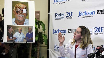 Le Pr Kassira Wrood, du service de chirurgie r&eacute;paratrice de l'h&ocirc;pital Jackson Memorial de Miami (Floride), montre des photos de Ronald Poppo &agrave; la presse, le 12 juin 2012. (WILFREDO LEE / AP / SIPA)