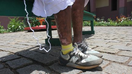 La lèpre sévit toujours sur l'île de Madagascar. (PICTURE ALLIANCE / PICTURE ALLIANCE / VIA GETTY IMAGES)