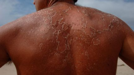 Contre le cancer de la peau, la surveillance des grains de beauté reste indispensable (Getty images - Robert Benson)