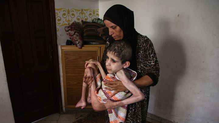 Sahar, une femme palestinienne, porte son fils de 19 ans, Bahaa al-Nimr, qui souffre de paralysie cérébrale et de malnutrition, à Sheikh Radwan, un quartier de la ville de Gaza, le 2 juillet 2024. (OMAR AL-QATTAA / AFP)