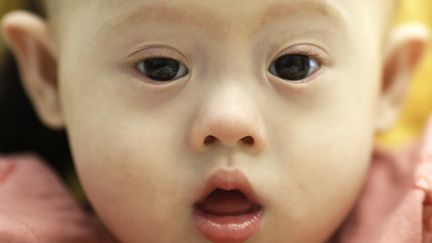 Gammy, b&eacute;b&eacute; trisomique pr&eacute;tendument abandonn&eacute; &agrave; sa m&egrave;re porteuse, dans un h&ocirc;pital de la province de Chonburi (Tha&iuml;lande), le 3 ao&ucirc;t 2014. (DAMIR SAGOLJ / REUTERS )