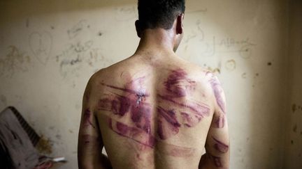 Un rebelle syrien montre les marques laiss&eacute;es par les actes de torture r&eacute;alis&eacute;s par des militaires, Alep (Syrie), le 23 ao&ucirc;t 2012. (JAMES LAWLER DUGGAN / AFP)