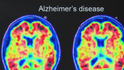 Alzheimer : "c’est une maladie qui est très compliquée", estime l’humoriste Tom Villa (Franceinfo)