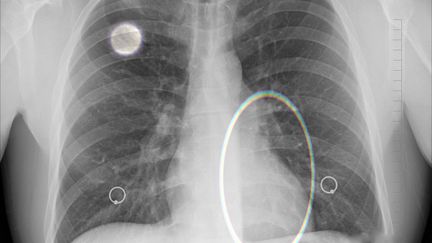 Une radiographie des poumons, le 21 janvier 2020. (PATRICK LEFEVRE / MAXPPP)