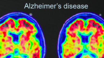 Santé : des essais cliniques encourageants pour guérir de la maladie d’Alzheimer ? (FRANCE 3)