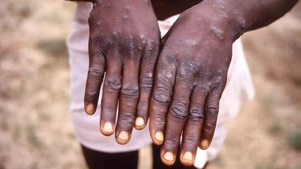 The hands of a patient suffering from MPOX, on September 27, 2022, in the Democratic Republic of Congo. (CDC / IMAGE POINT FR / AFP)