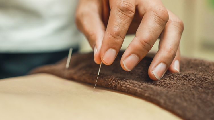 L'acupuncture est-elle efficace ?