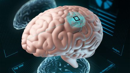 Bientôt des implants cérébraux greffés directement dans le cerveau pour contrôler des machines ? Photo d'illustration. (SERGII IAREMENKO/SCIENCE PHOTO L / SCIENCE PHOTO LIBRARY RF/ GETTY IMAGES)