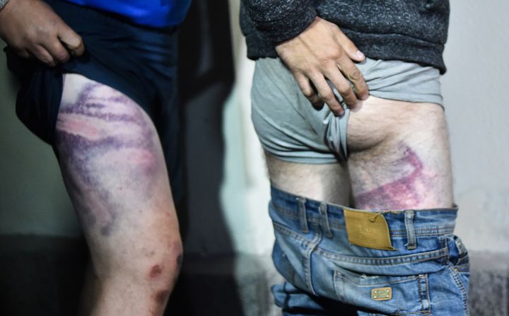 Deux hommes détenus après leur arrestation en marge de manifestations en Biélorussie montrent les marques des coups qu'ils disent avoir reçus en détention, à leur sortie de prison à Minsk, le 14 août 2020. (SERGEI GAPON / AFP)