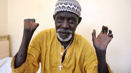 Patient sénégalais qui montre ses mains après avoir reçu un traitement et avoir été guéri de la lèpre.&nbsp;&nbsp; (SEYLLOU / AFP)