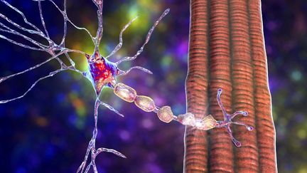 Une modélisation de la&nbsp;démyélinisation, une détéorioration de&nbsp;la gaine de myéline des neurones, observée dans une maladie comme&nbsp;la sclérose en plaques.&nbsp; (KATERYNA KON/SCIENCE PHOTO LIBRA / KKO / AFP)