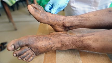 Un dermatologue d'un hôpital d'Abidjan, en Côte d'Ivoire, examine les pieds abîmés d'une Ivoirienne s'étant dépigmenté la peau à l'aide de corticoïdes, le 11 mars 2019.&nbsp; (SIA KAMBOU / AFP)