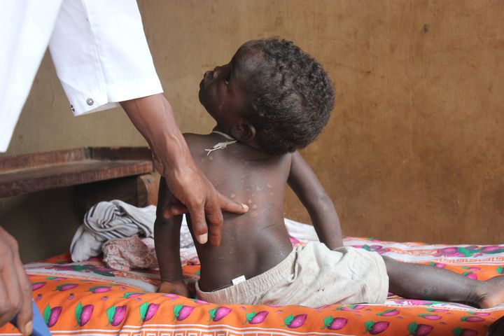 Enfant malagache de deux ans, dont la mère est atteinte par la lèpre et dont le diagnostic demeure incertain malgré les taches pointées dans son dos. Marana (Madagascar), le 23 janvier 2018. (LAETITIA BEZAIN / DPA)