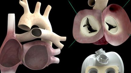  (La société Carmat va reprendre son essai sur le coeur artificiel © Maxppp)