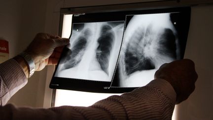 Un médecin consulte la radio d'un patient atteint de tuberculose à Thionville (Moselle), le&nbsp;13 janvier 2014. (MAXPPP)