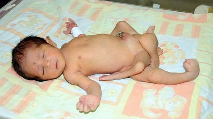 Photo d'un b&eacute;b&eacute; n&eacute; avec six jambes diffus&eacute;e le 16 avril 2012 par l'Institut national de la sant&eacute; de l'enfant &agrave; Karachi (Pakistan). (HO / NICH)