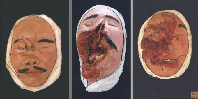 Visages blessés. Moulage en plâtre peint rehaussé de cire
 (Musée du Service de santé des armées au Val-de-Grâce, Paris)