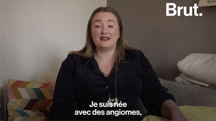 Julie est née avec des taches de naissance sur 70 % de son corps. Elle raconte.