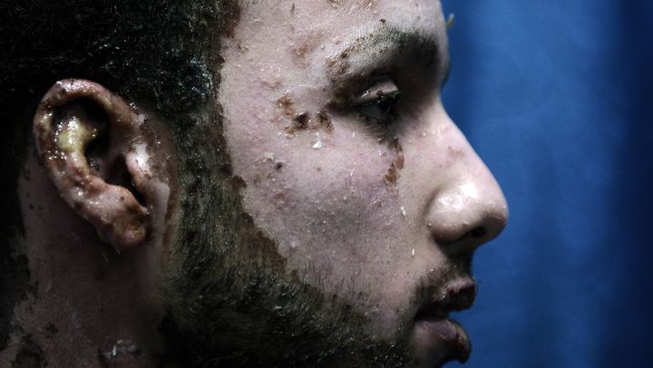 Un Palestinien souffrant de br&ucirc;lures au phosphore blanc, &agrave; l'h&ocirc;pital&nbsp;Al-Shifa de Gaza, le 22 janvier 2009. (OLIVIER LABAN-MATTEI / AFP)