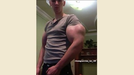 Kirill s’est injecté de l’huile de synthol dans les bras pendant dix jours.