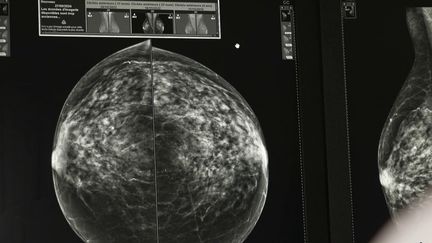 Santé : quand l’intelligence artificielle peut prédire le cancer du sein