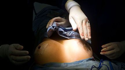 Des chirurgiens retirent des prothèses mammaires dans une clinique de Medellin, en Colombie, le 5 avril 2013.  (AFP PHOTO / Raul ARBOLEDA)