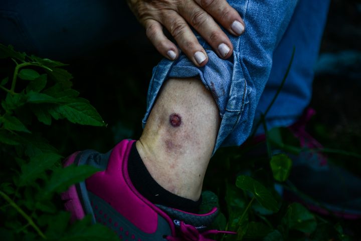 Un opposant au gouvernement montre une blessure sur sa cheville après une manifestation à Caracas, le 14 juin 2017. (FEDERICO PARRA / AFP)