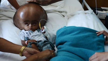 Roona Begum, une petite fille &acirc;g&eacute;e de 15 mois souffrant d'hypertrophie du cr&acirc;ne, attend d'&ecirc;tre op&eacute;r&eacute;e &agrave; l'h&ocirc;pital de Gurgaon (Inde), le 17 avril 2013. (ROBERTO SCHMIDT / AFP)