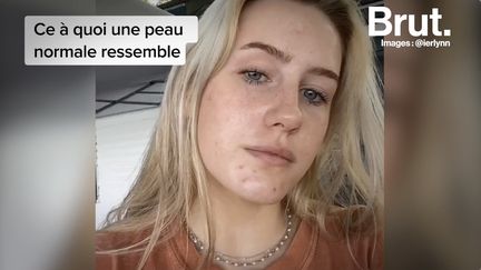 VIDEO. Ces jeunes qui assument leur acné sur les réseaux (BRUT)