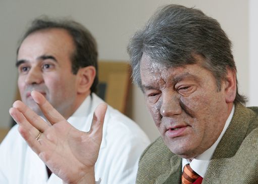 ​Viktor Ioutchenko, défiguré, le 12 décembre 2004 lors d'une conférence de presse avec son médecin à Vienne (Autriche) (REUTERS - Heinz-Peter Bader HPB/AA)