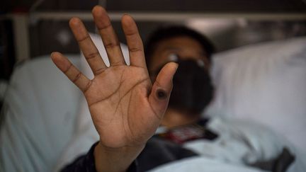 A patient infected with Mpox shows her infected hand on August 16, 2022. (ERNESTO BENAVIDES / AFP)