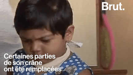 Ishita Jawale, une petite indienne âgée de 4 ans, a reçu une greffe du crâne. Elle est la première personne de son pays a subir cette lourde opération.