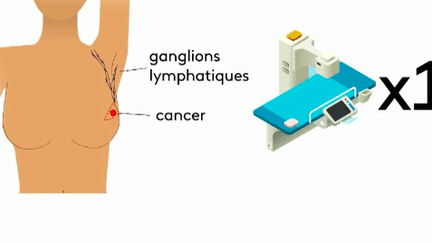 Santé : réduction du nombre de séances de radiothérapie pour le cancer du sein