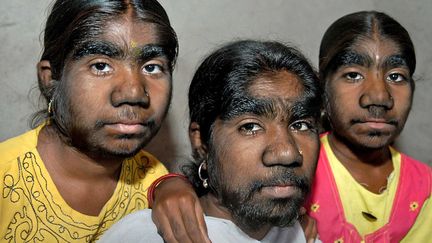 Ceci n'est pas un photomontage mais trois soeurs indiennes atteinte d'hypertrichose, une maladie g&eacute;n&eacute;tique qui aurait donn&eacute; naissance au mythe du loup-garou, Pune (Inde), le 7 f&eacute;vrier 2012. (CATERS NEWS AGENCY / SIPA)