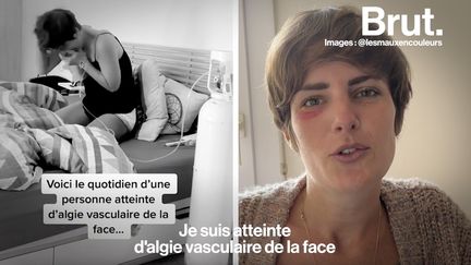 Âgée de 31 ans, Diane partage son quotidien sur les réseaux : elle est atteinte d’algie vasculaire de la face. Une maladie très douloureuse aussi appelée “la maladie du suicide”. Brut l’a rencontrée.